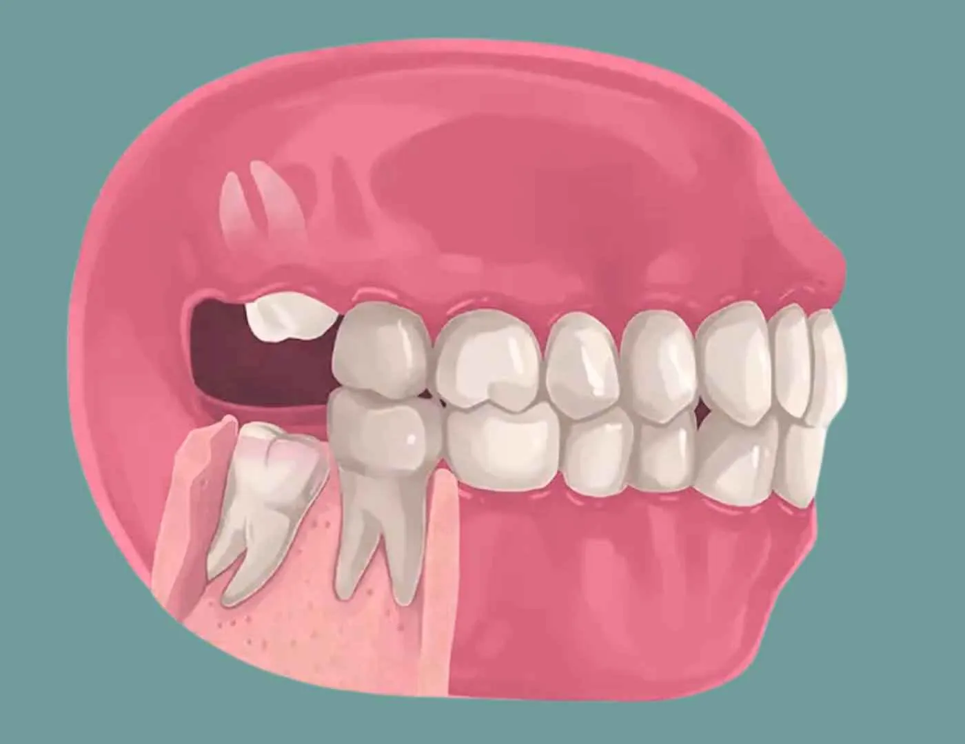 Wisdom Tooth Extraction